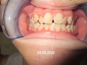 Hier der Beginn der Therapie