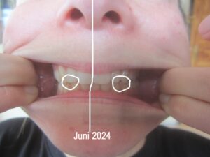 Nach der Behandlung stehen die Zähne viel besser und das Schlucken ist physiologisch