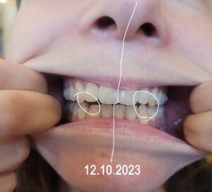 Patientin nach einer langen KFO-Behandlung kam sie zu mir.